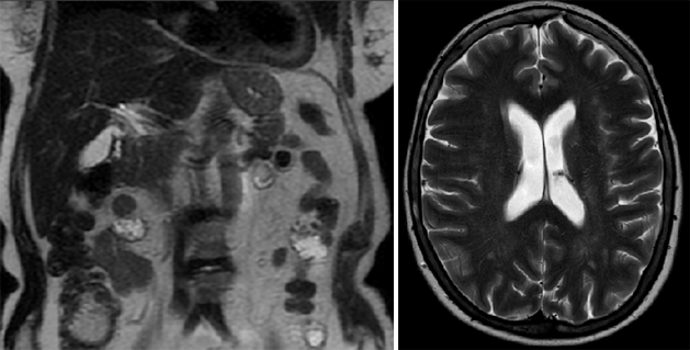 T2 weighted imaging